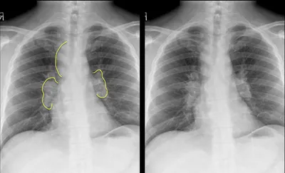Garland's Triad in Sarcoidosis