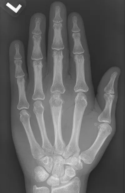 Osteomyelitis with Codman's triangle