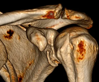 Bankart fracture of anteroinferior glenoid