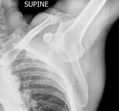 Inferior glenohumeral dislocation