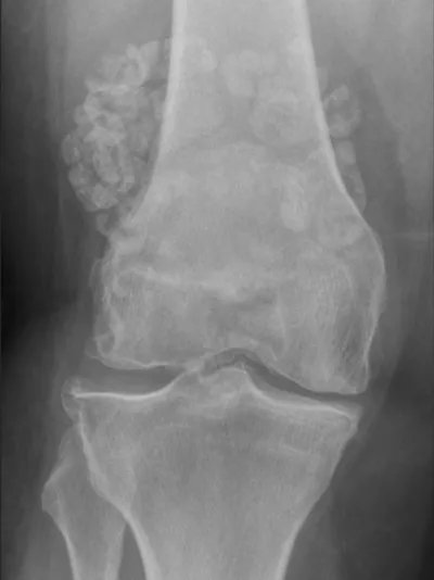 Synovial osteochondromatosis