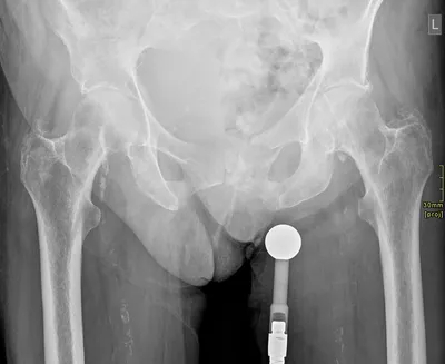 Left sided pubic ramal fractures
