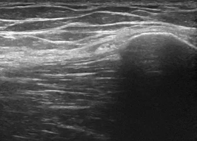 Lateral femoral cutaneous nerve