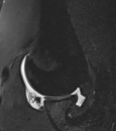 Anterior labral tear on ABER view