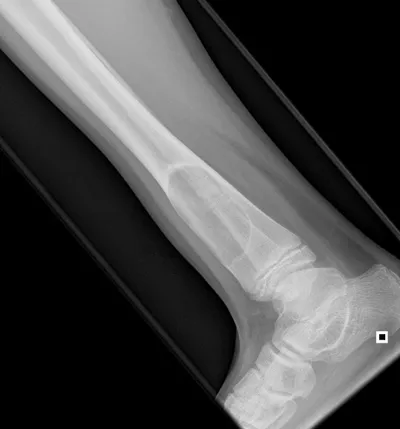 Non Ossifying Fibroma