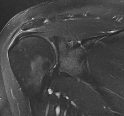 Subacromial bursitis