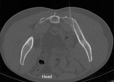 Sacroiliac joint injection (CT guided)