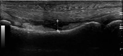 A2 annular pulley injury with bowstring deformity of flexor tendon