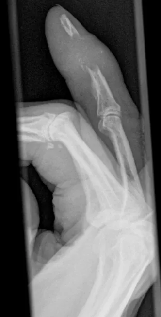 Metastatic bone destruction distal phalanx