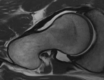 Anterior acetabular labral tear at chondrolabral junction
