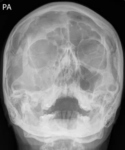 Right zygomaticomaxillary complex (ZMC) fracture