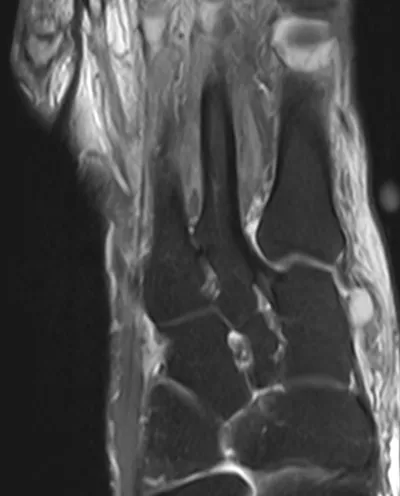 Lis Franc Ligament - intact