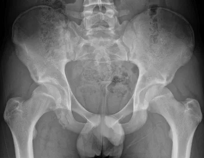 Right hamstring origin apophyseal avulsion