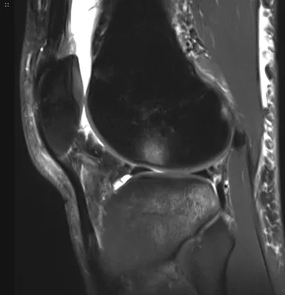 Pivot shift bone bruising pattern