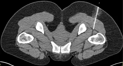 Ischiofemoral space injection for ischiofemoral impingement