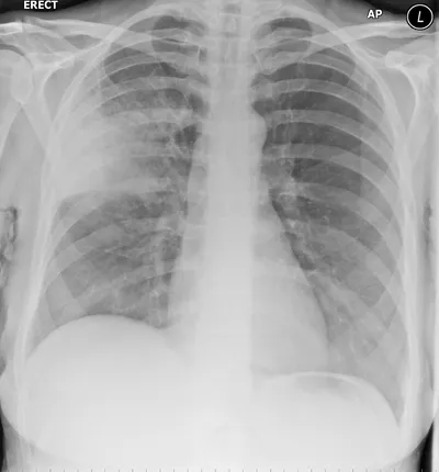 Right Upper Lobe Consolidation