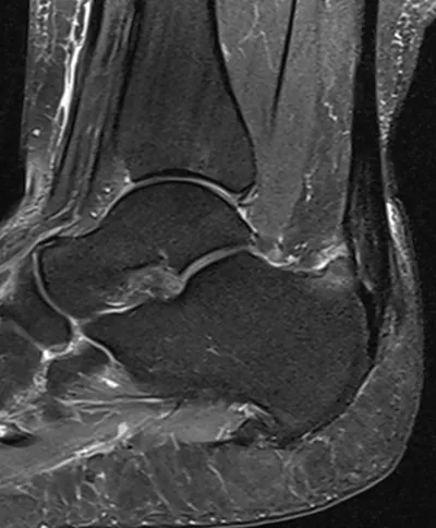 Haglund Deformity + insertional Achilles tendinopathy