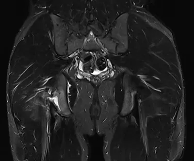 Right common hamstring tendon apophyseal avulsion