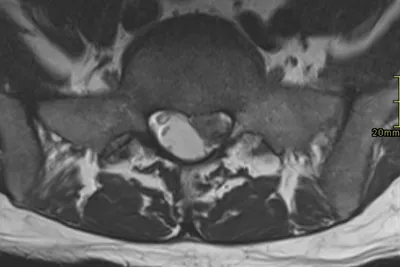 Left S1 nerve compression due to extruded disc