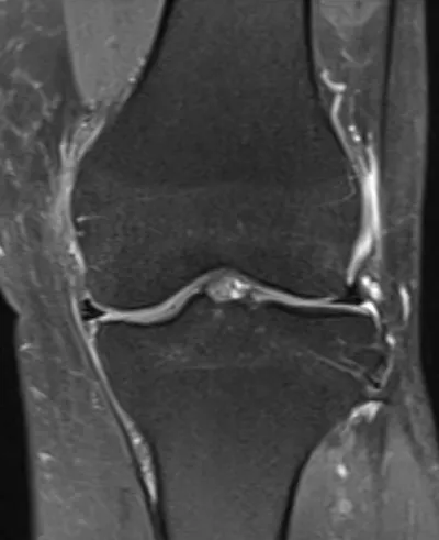 Iliotibial bursitis