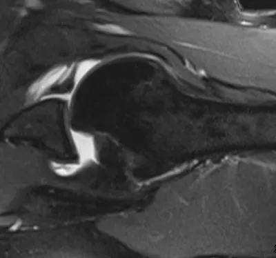 Hill Sachs defect and Bankart lesion