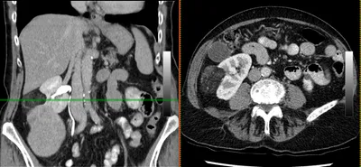 Right Kidney Masses - fatty and solid. Angiomyolipoma with coexisting renal cell carcinoma