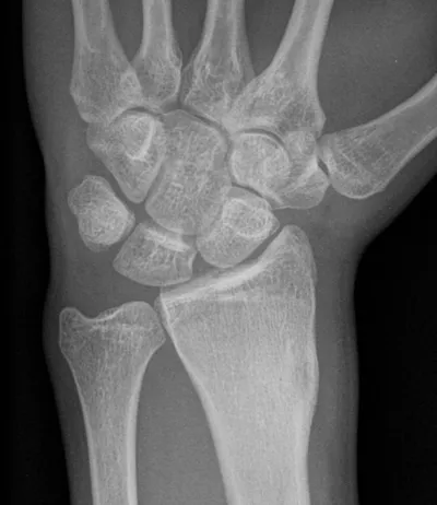 Osteoid Osteoma
