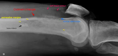 Osteosarcoma with Codman's triangle