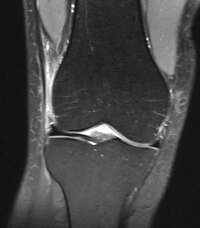 Iliotibial band friction syndrome