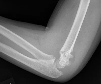 Supracondylar fracture of elbow