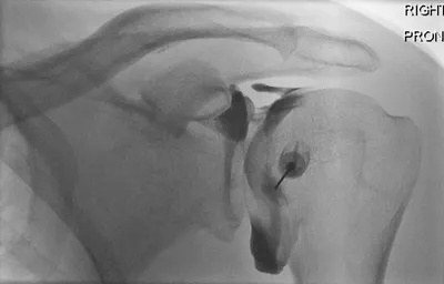 Shoulder glenohumeral arthrogram