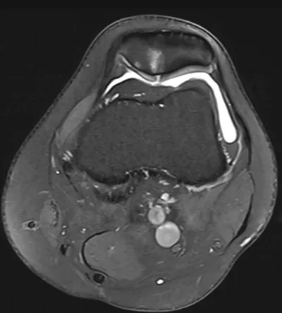 Cartilage fissure at patellar apex