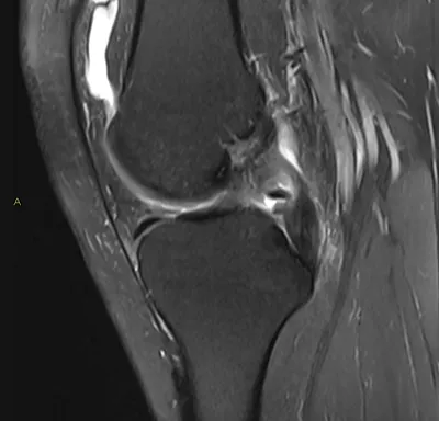 Posterior Cruciate Ligament (PCL) tear