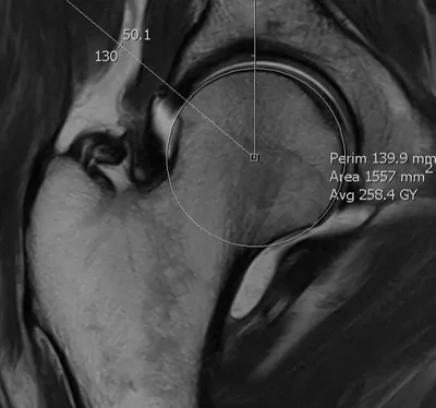 Pincer morphology of acetabulum