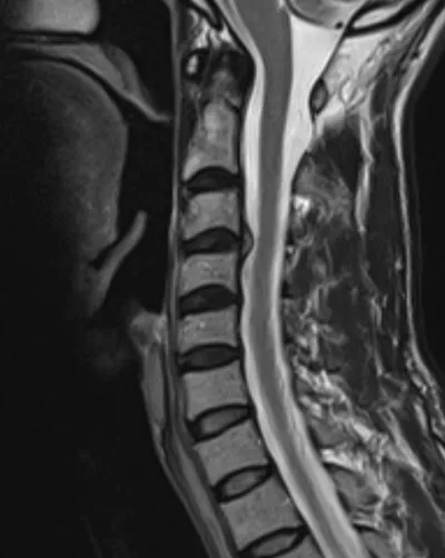 Cervical disc herniation