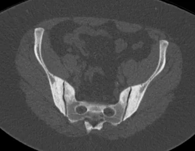 Osteitis condensans ilii