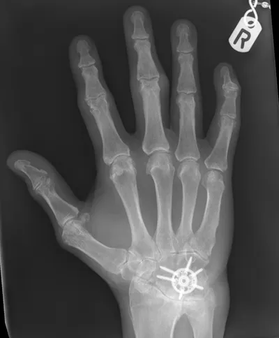 4-Corner carpal fusion of wrist
