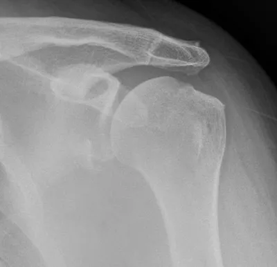 Bankart fracture of glenoid rim