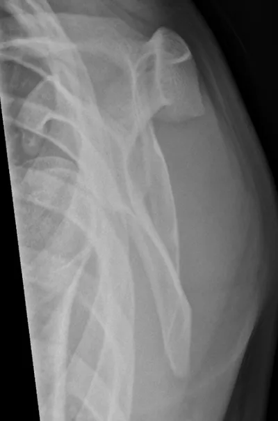 Anterior glenohumeral dislocation on scapular Y-View