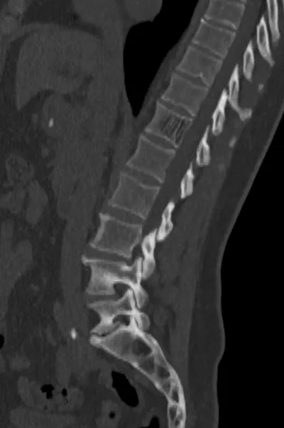 Vertebral haemangioma