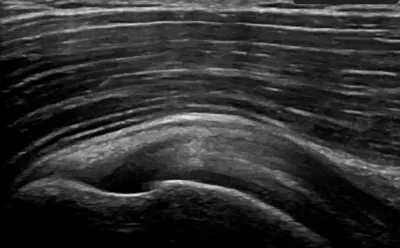Intact Supraspinatus Tendon