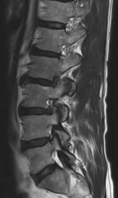 Foraminal disc herniation