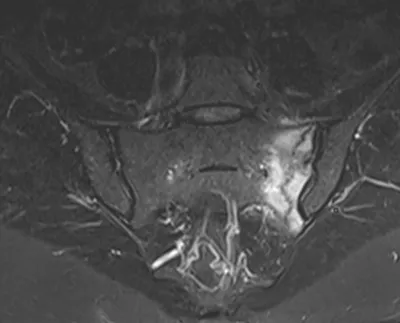 Left sacral insufficiency fracture