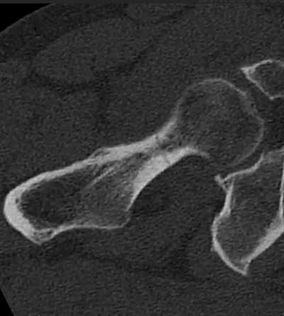 Occult hip fracture