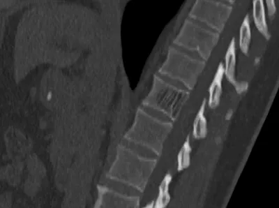 Vertebral haemangioma