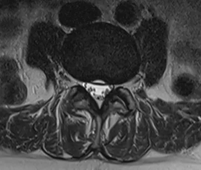 Transverse annulus tear of intervertebral disc