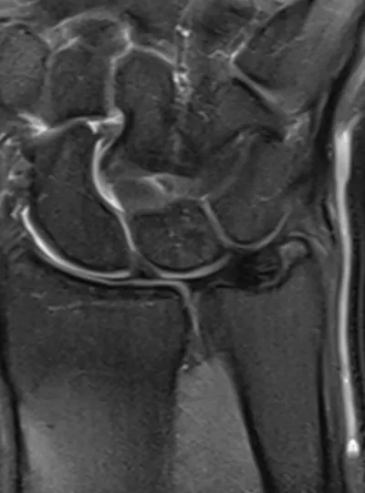 Normal Triangular Fibrocartilage Complex (TFCC)