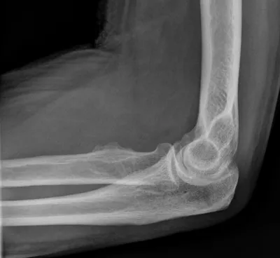 Radial tuberosity enthesitis (distal biceps)