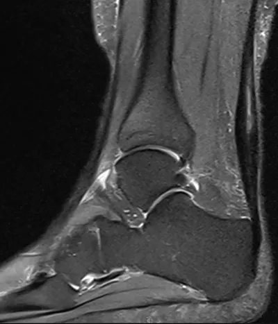 Achilles tendon split tear