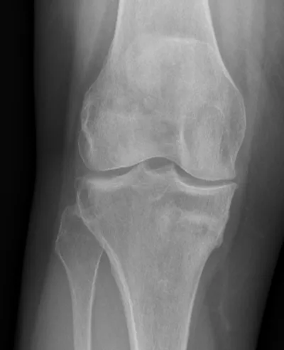 Healing medial tibial stress fracture